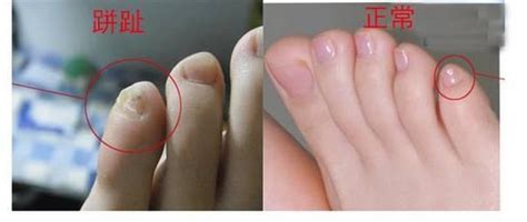 螞蟻 大量 出現 徵兆 小腳指甲分瓣
